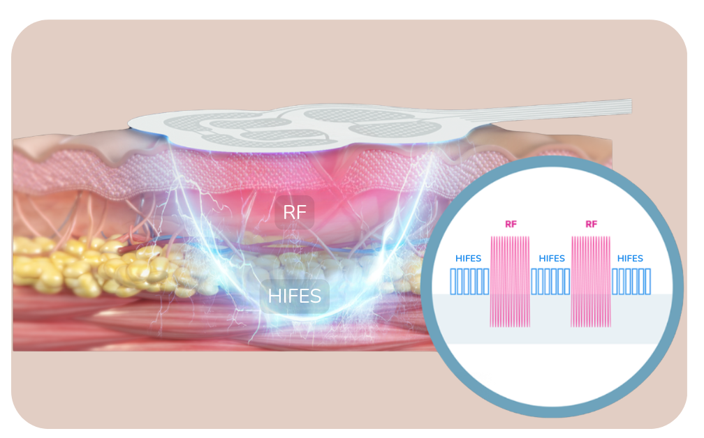 Illustration de la double technologie HIFES + RF