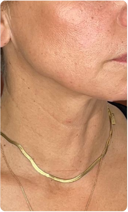 Après traitement Sculptface