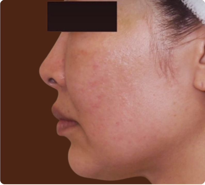 Après traitement Cryolipolyse