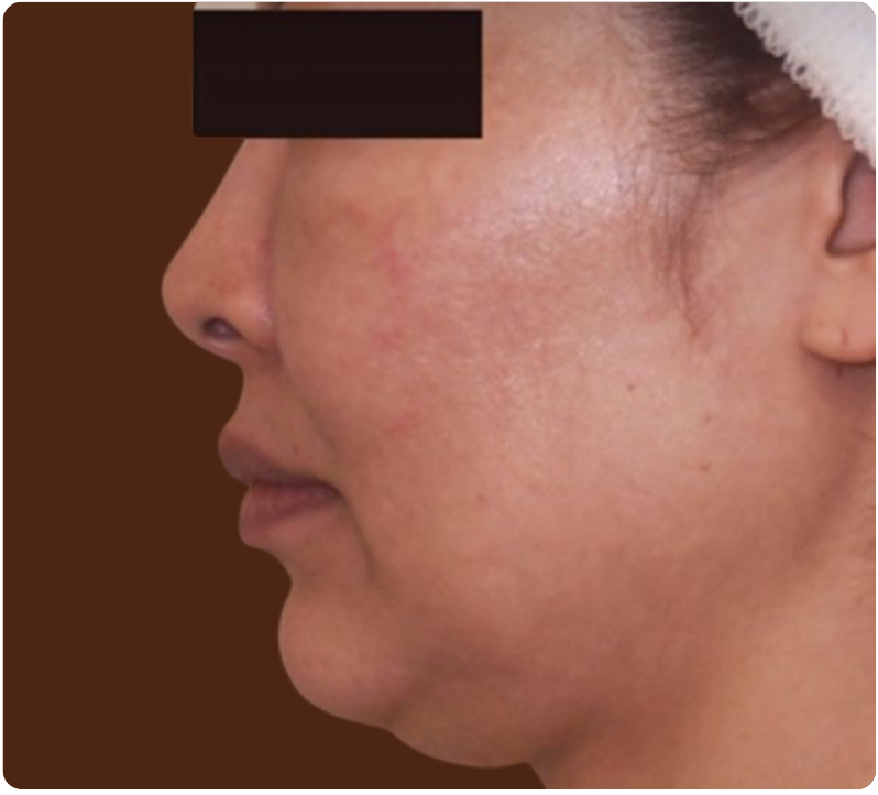 Avant traitement Cryolipolyse